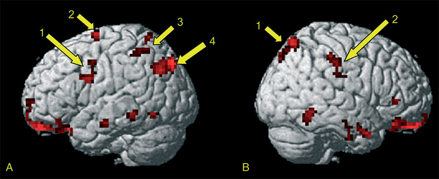 A imagem apresenta os efeitos da experiência motora prévia nas respostas cerebrais à observação de uma dança. As setas indicam as áreas previstas com ativações significativas. Reprodução do trabalho original disponível em doi:10.1093/cercor/bhi007